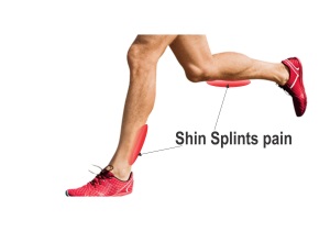 shin splints